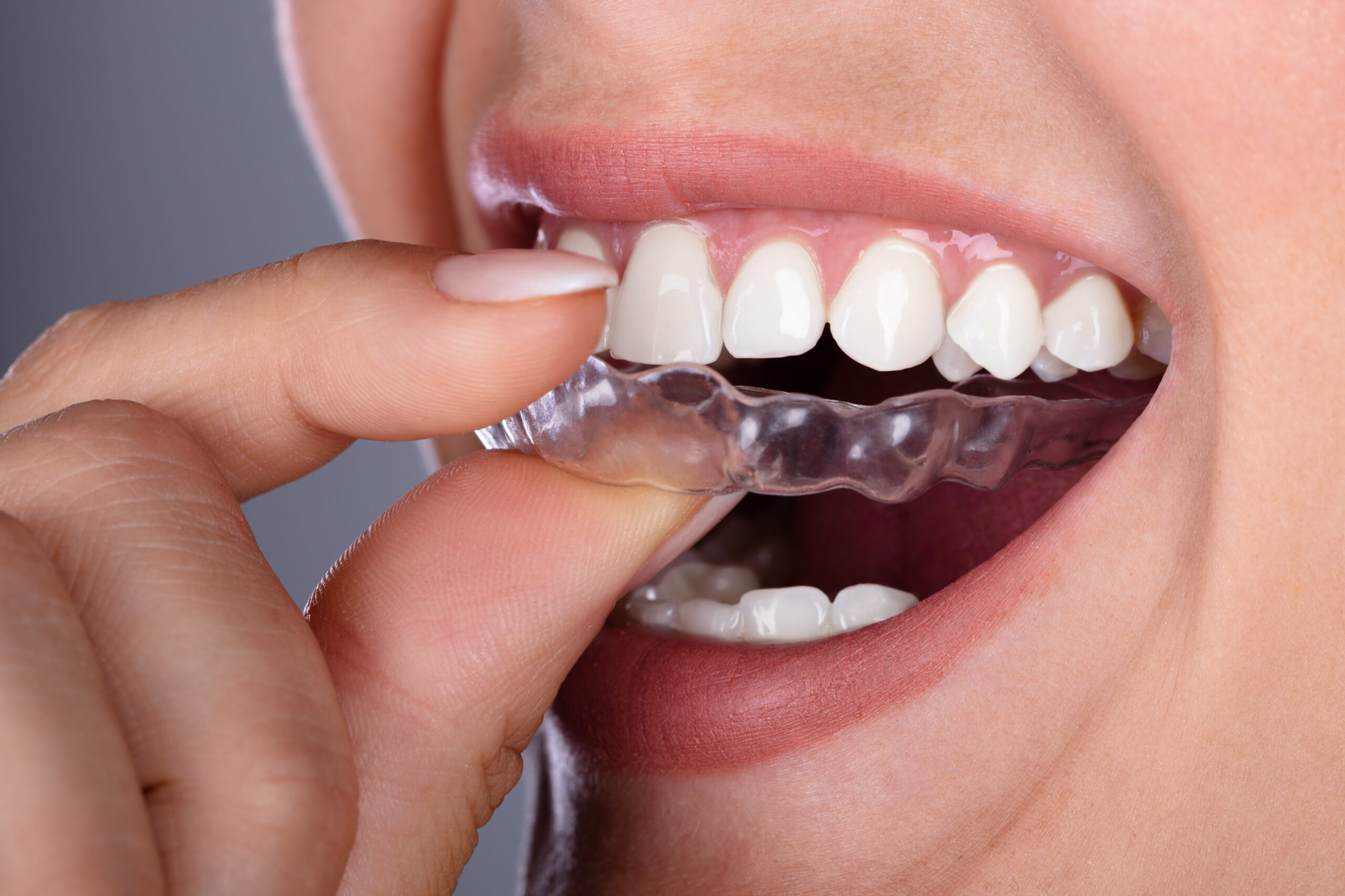 Clear Aligner Close Up