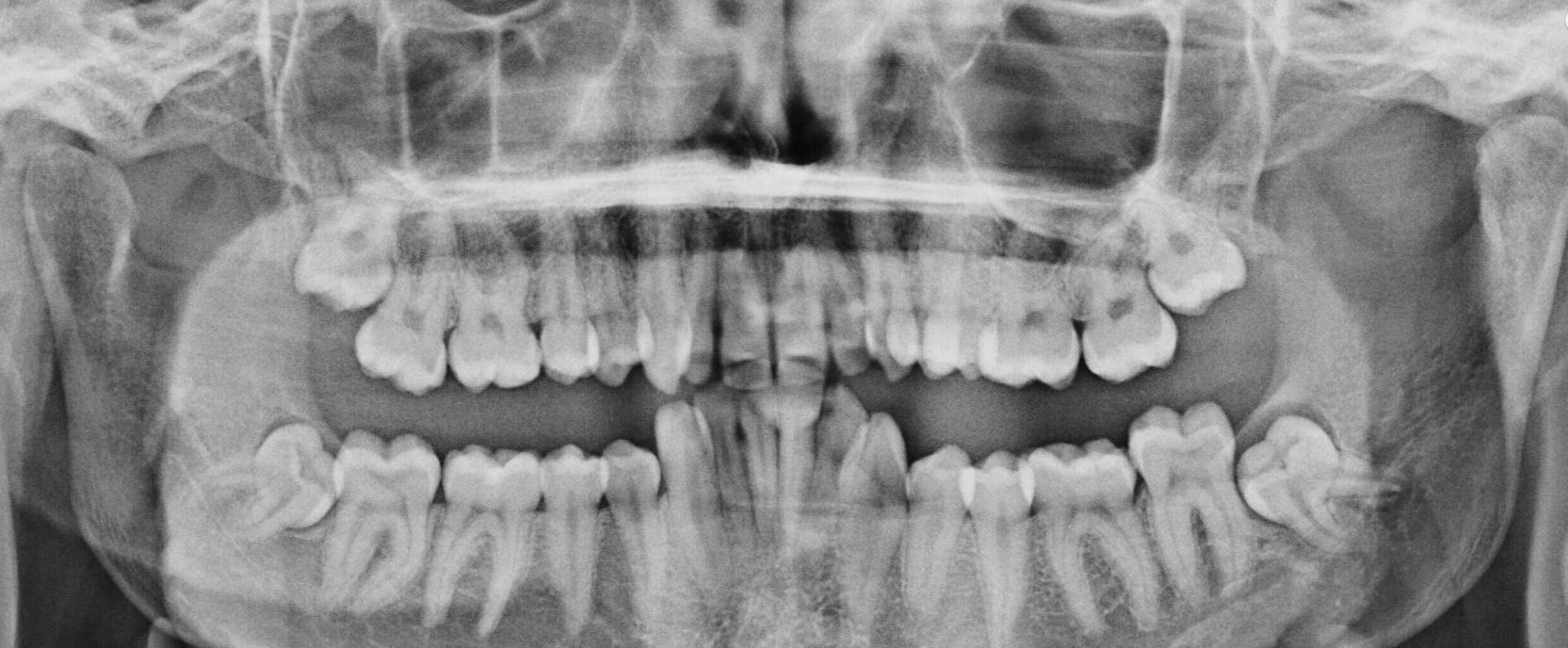 Wisdom Tooth OPG