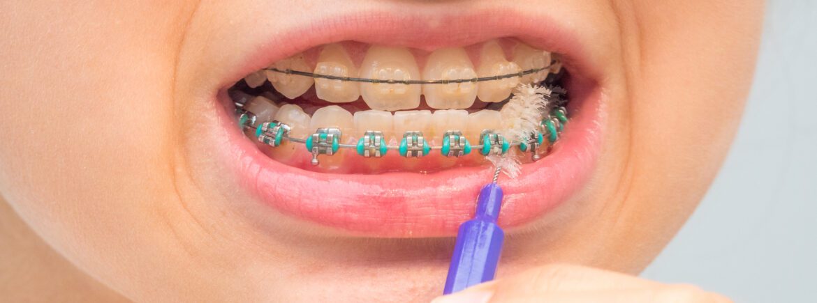 dental braces and oral hygiene