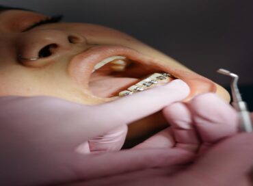 Orthodontic Treatment in Perth