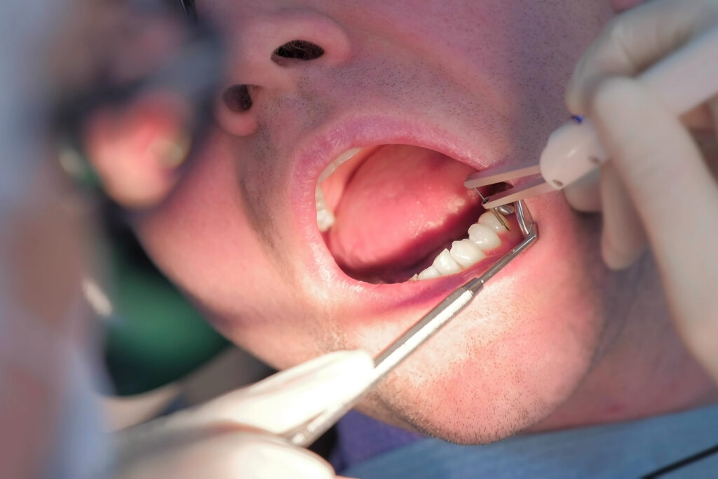 Gum Disease Treatment in Perth