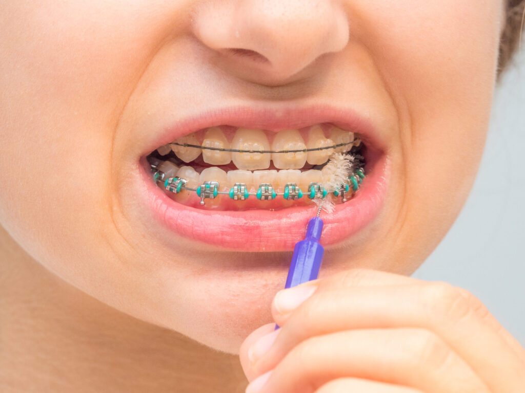 dental braces perth
