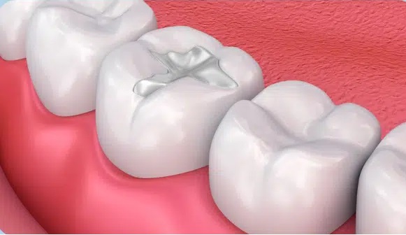 dental fillings perth