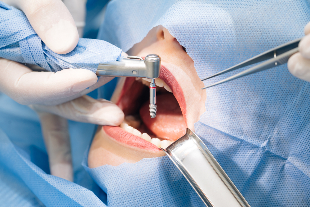 dental implants perth