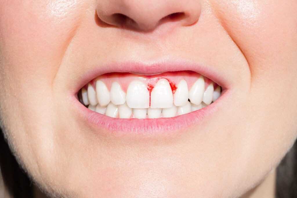 gum disease treatment in perth