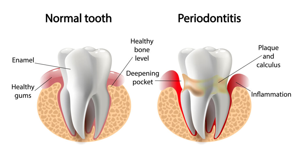 gum disease treatment in perth