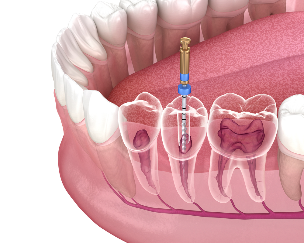 root canal treatment perth