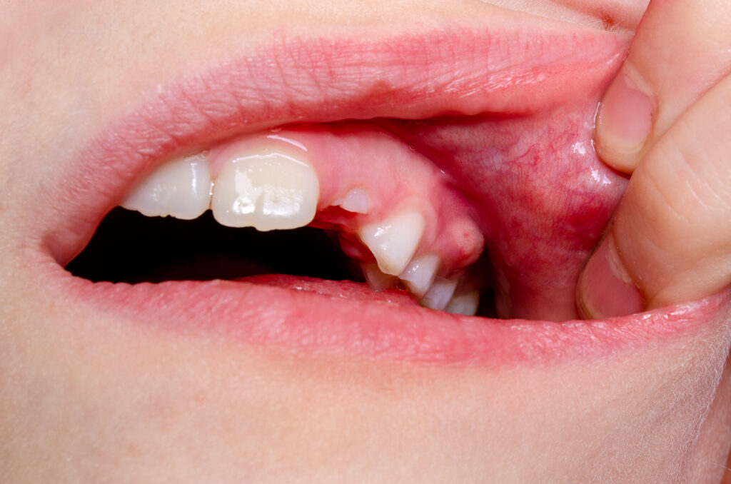 avoid dental emergencies