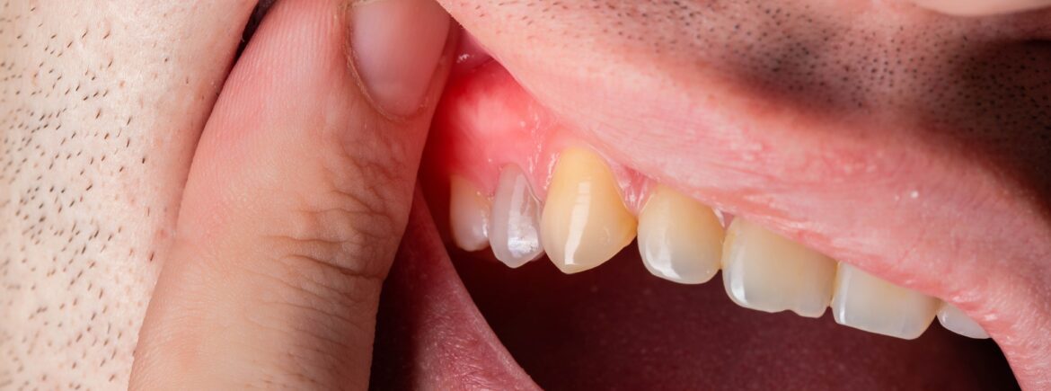 Dental Abscess