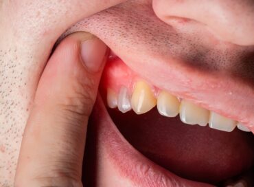 Dental Abscess