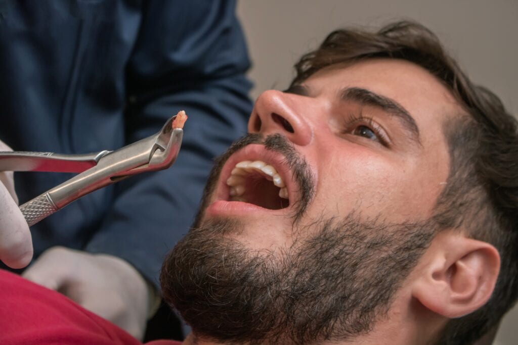 Types of Tooth Extractions