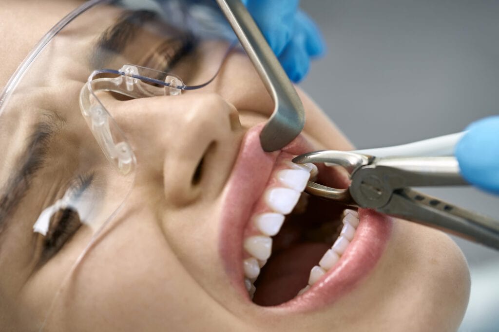 types of tooth extractions